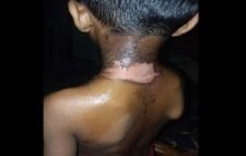 জৈন্তাপুরে শিশুর শরীর ঝলসে দিলেন মক্তবের শিক্ষক