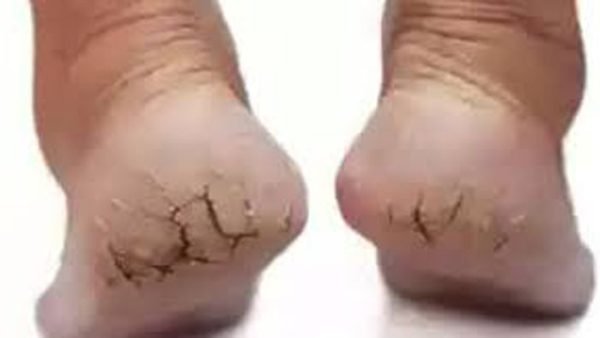 শীতে পা ফাটা রোধ করতে যা করবেন