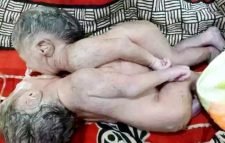 মৃত্যুর কাছে হেরে গেল জোড়া লাগা দুই শিশু